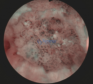 Bladder Cystoscopy