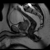 Prostate MRI